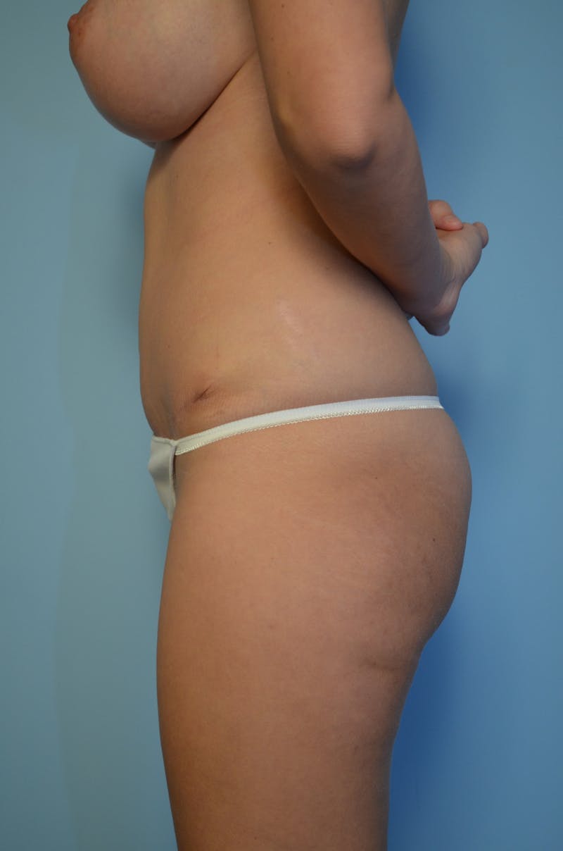 Tummy Tuck Before & After Gallery - Patient 144920 - Image 10