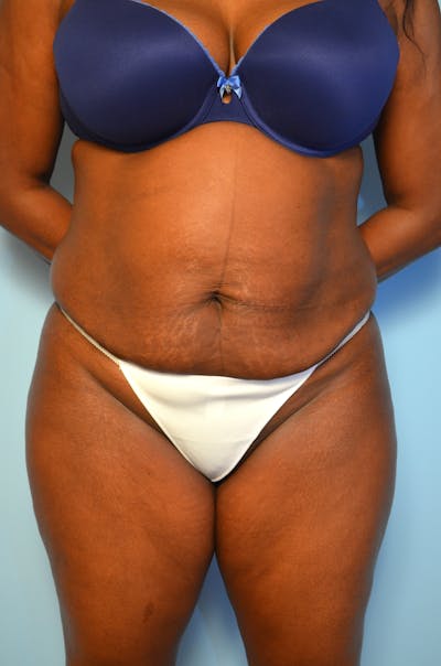 Tummy Tuck Before & After Gallery - Patient 311812 - Image 1