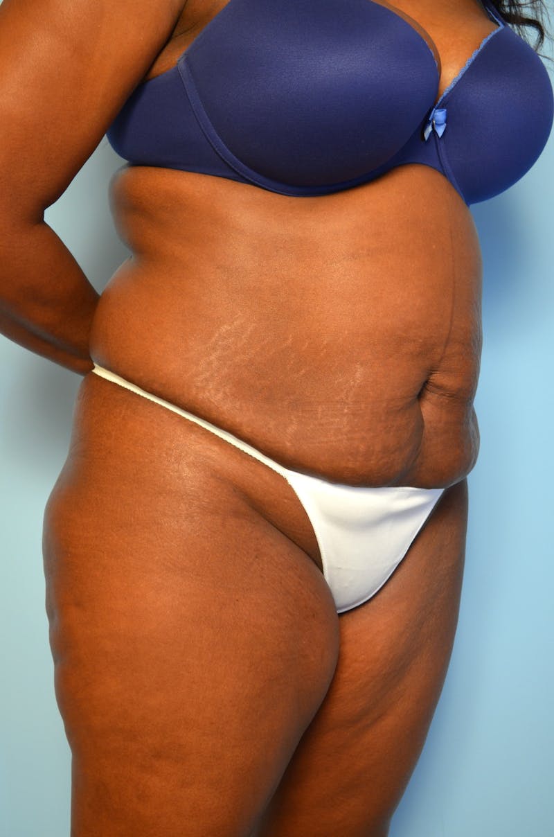 Tummy Tuck Before & After Gallery - Patient 311812 - Image 3