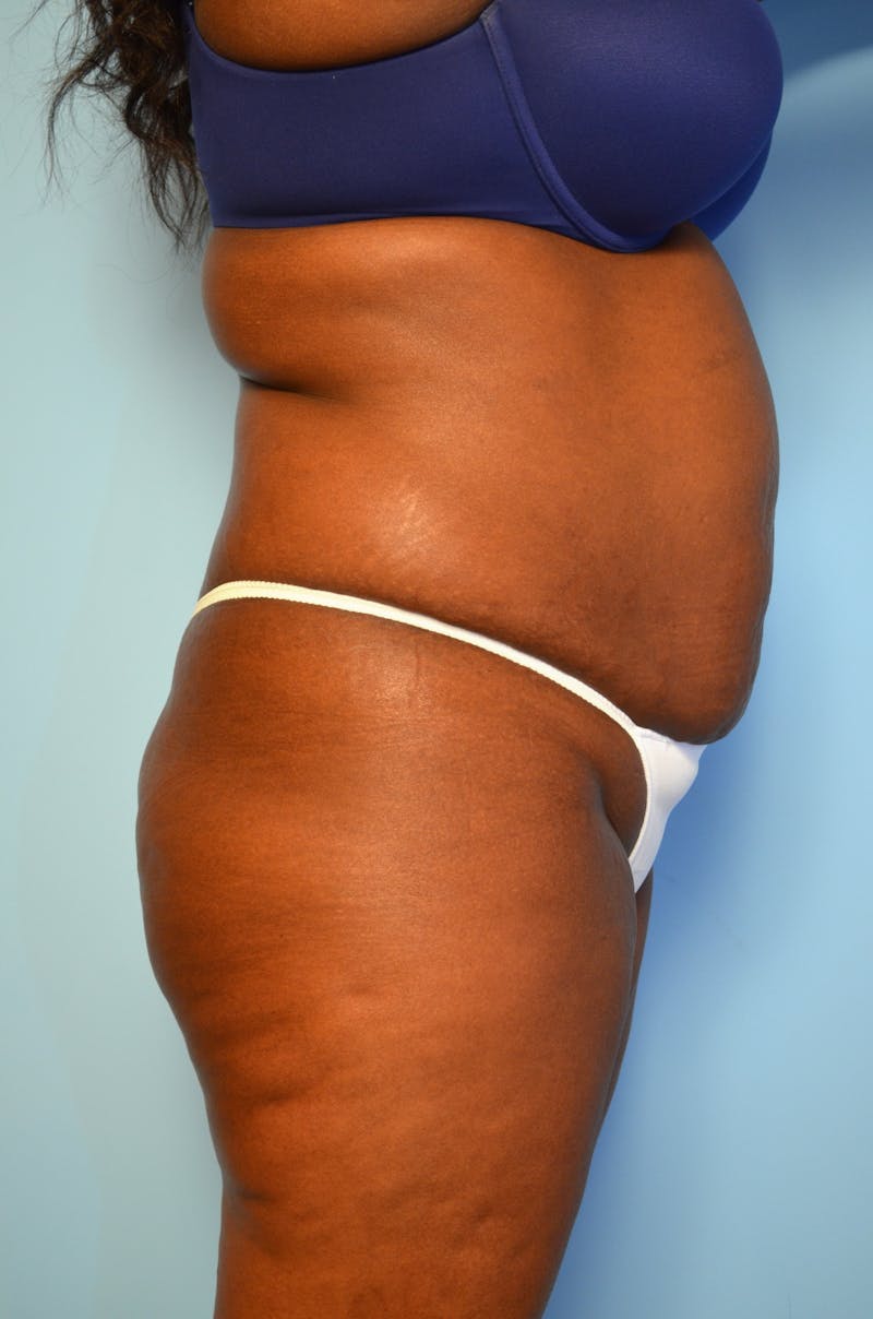Tummy Tuck Before & After Gallery - Patient 311812 - Image 5