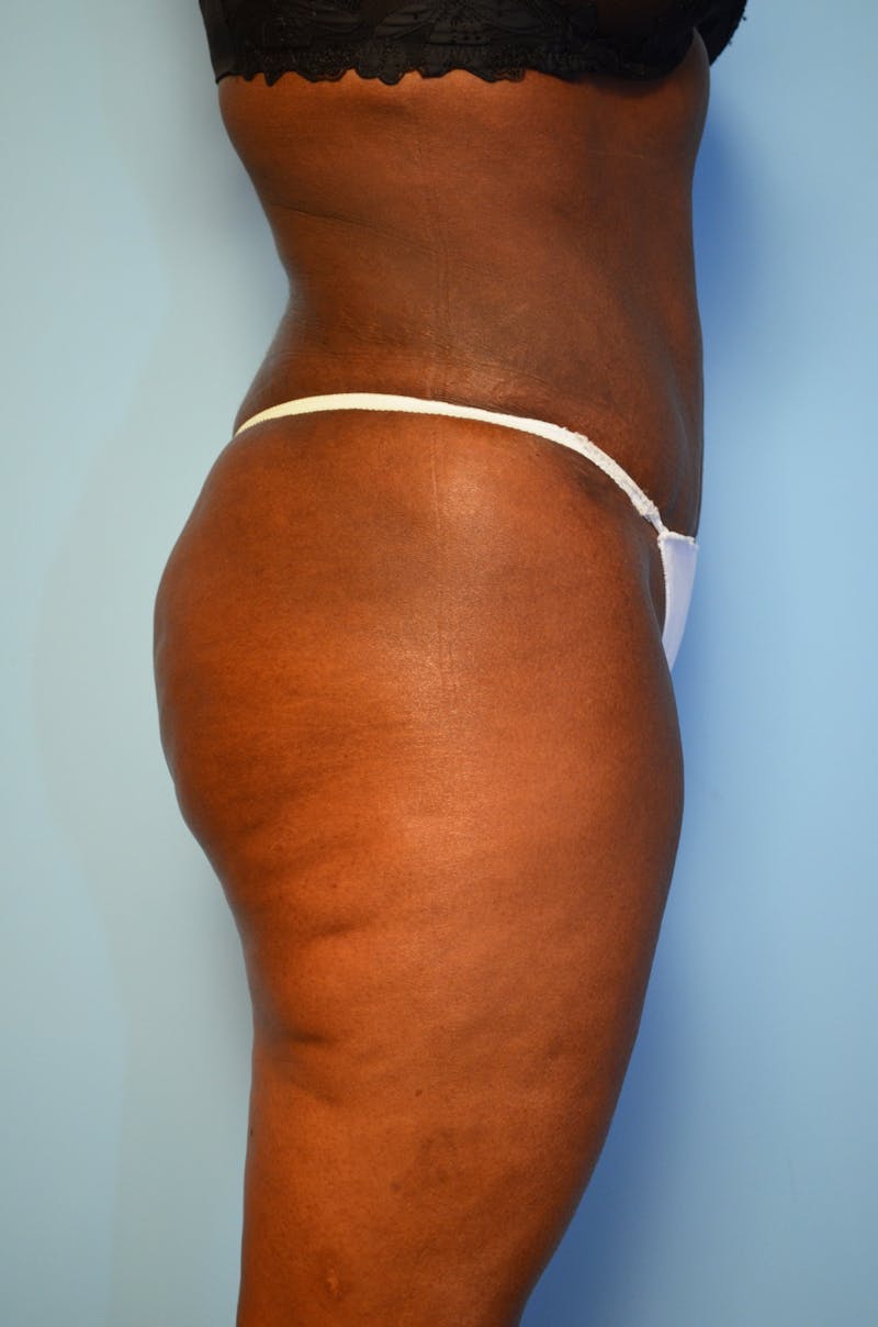 Tummy Tuck Before & After Gallery - Patient 311812 - Image 6