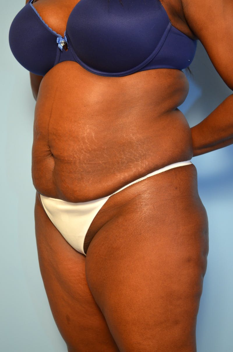 Tummy Tuck Before & After Gallery - Patient 311812 - Image 7