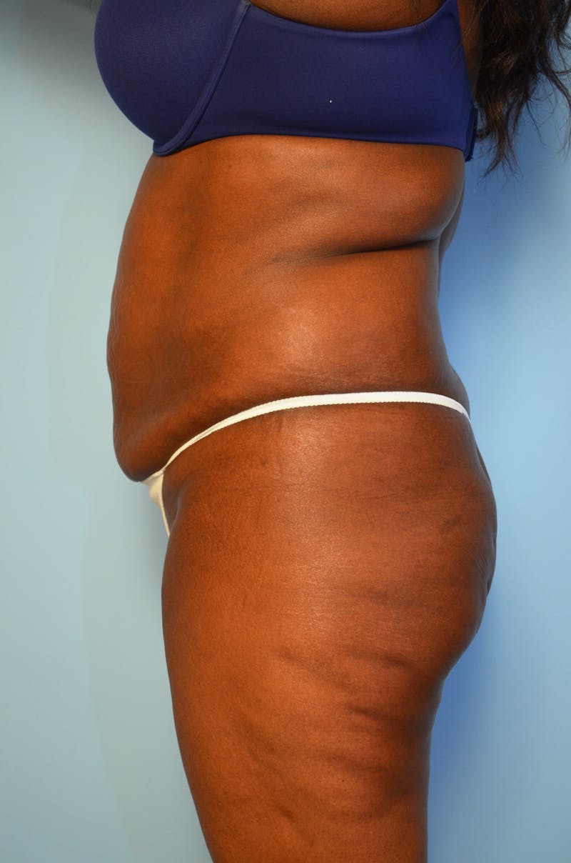 Tummy Tuck Before & After Gallery - Patient 311812 - Image 9