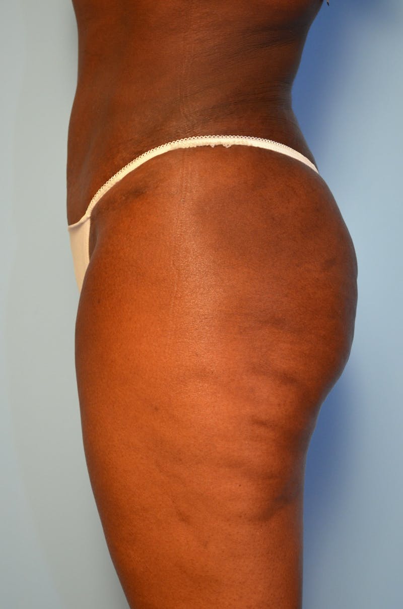 Tummy Tuck Before & After Gallery - Patient 311812 - Image 10