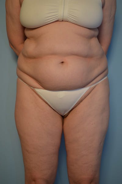 Tummy Tuck Before & After Gallery - Patient 405343 - Image 1