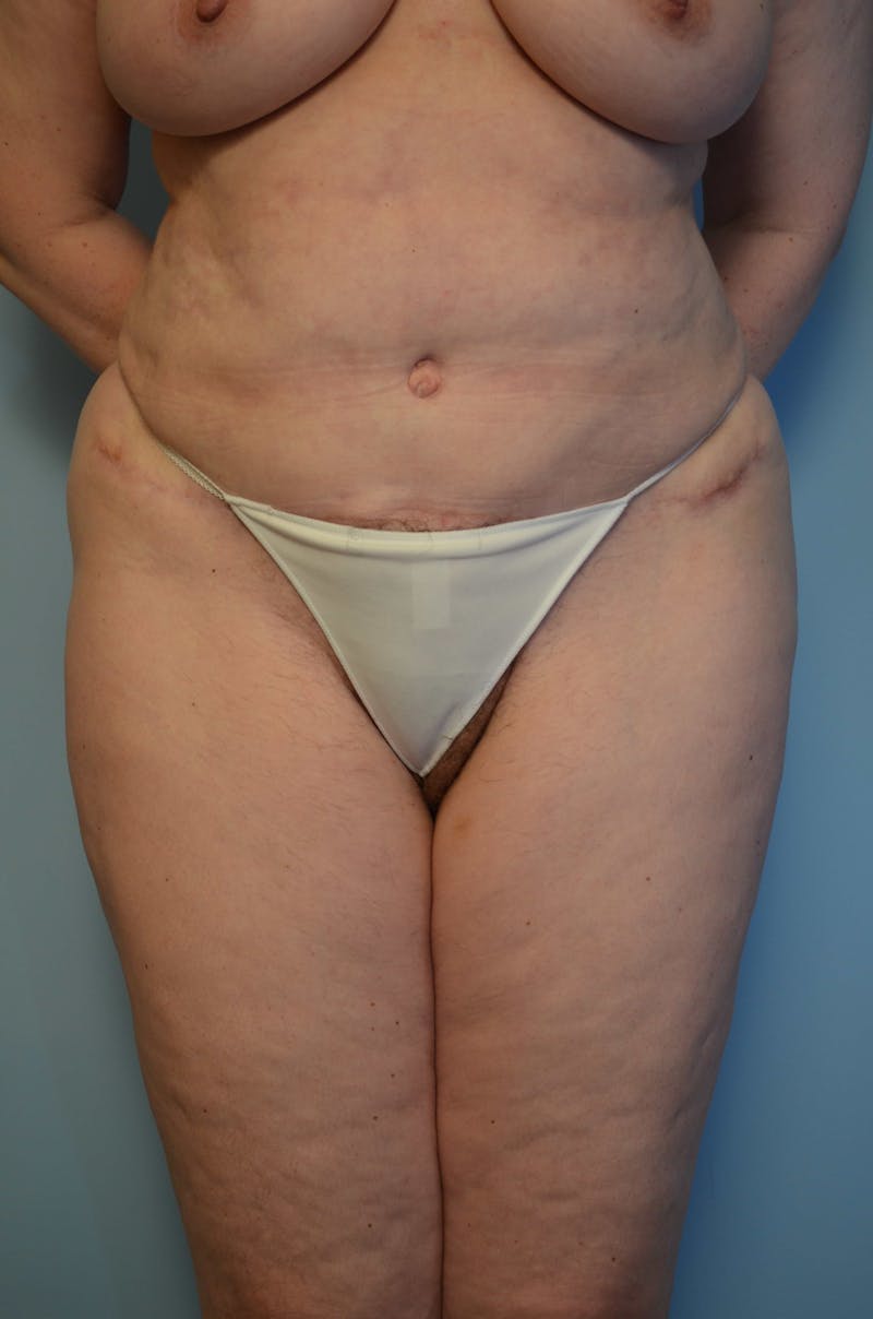 Tummy Tuck Before & After Gallery - Patient 405343 - Image 2