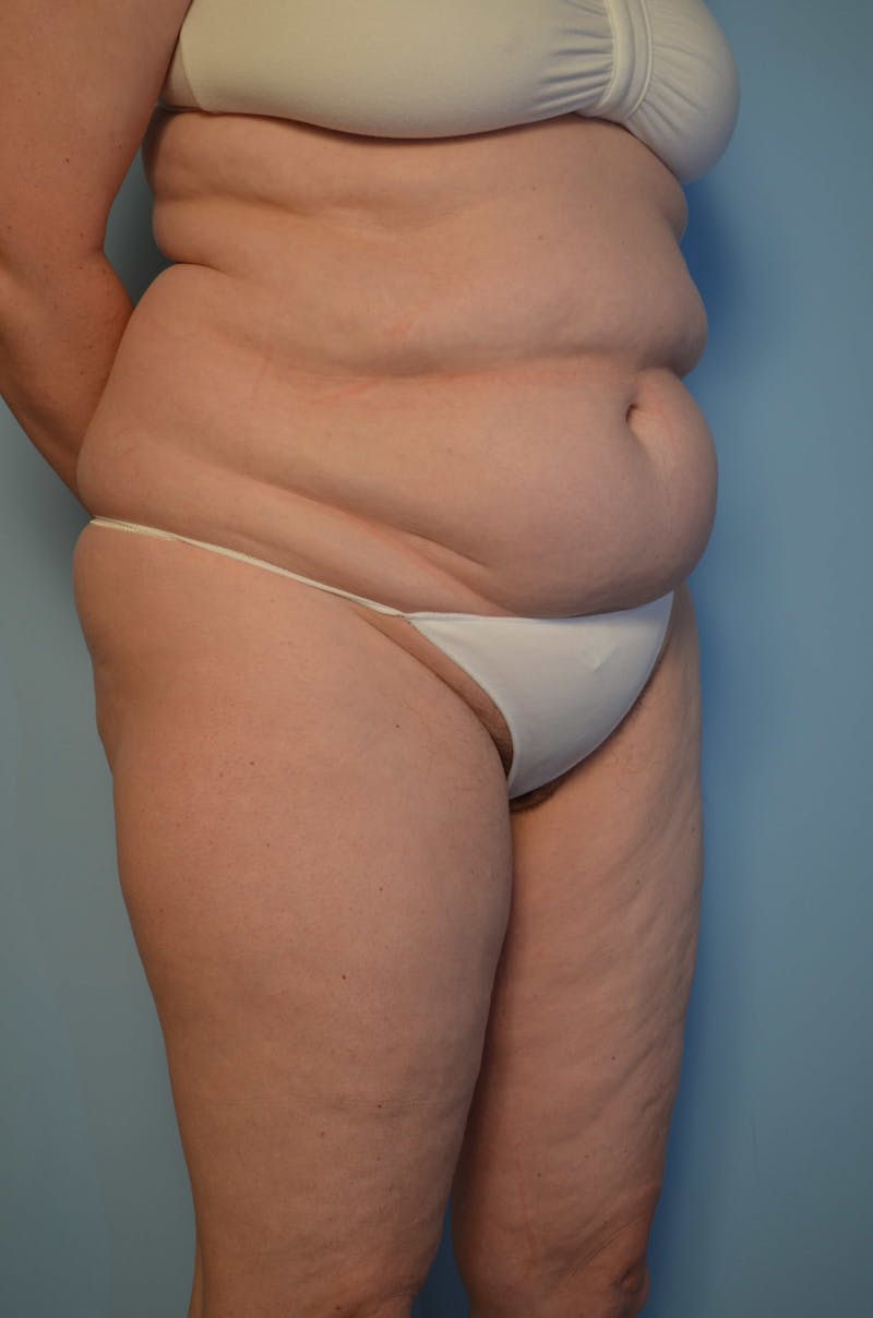 Tummy Tuck Before & After Gallery - Patient 405343 - Image 3