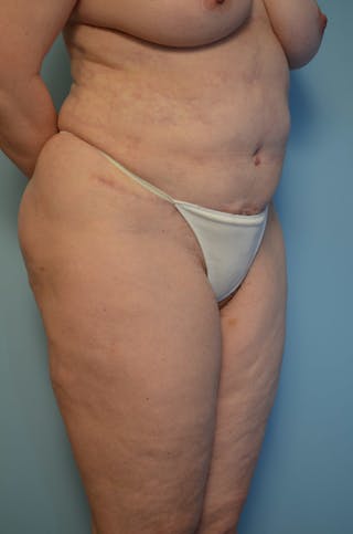 Tummy Tuck Before & After Gallery - Patient 405343 - Image 4