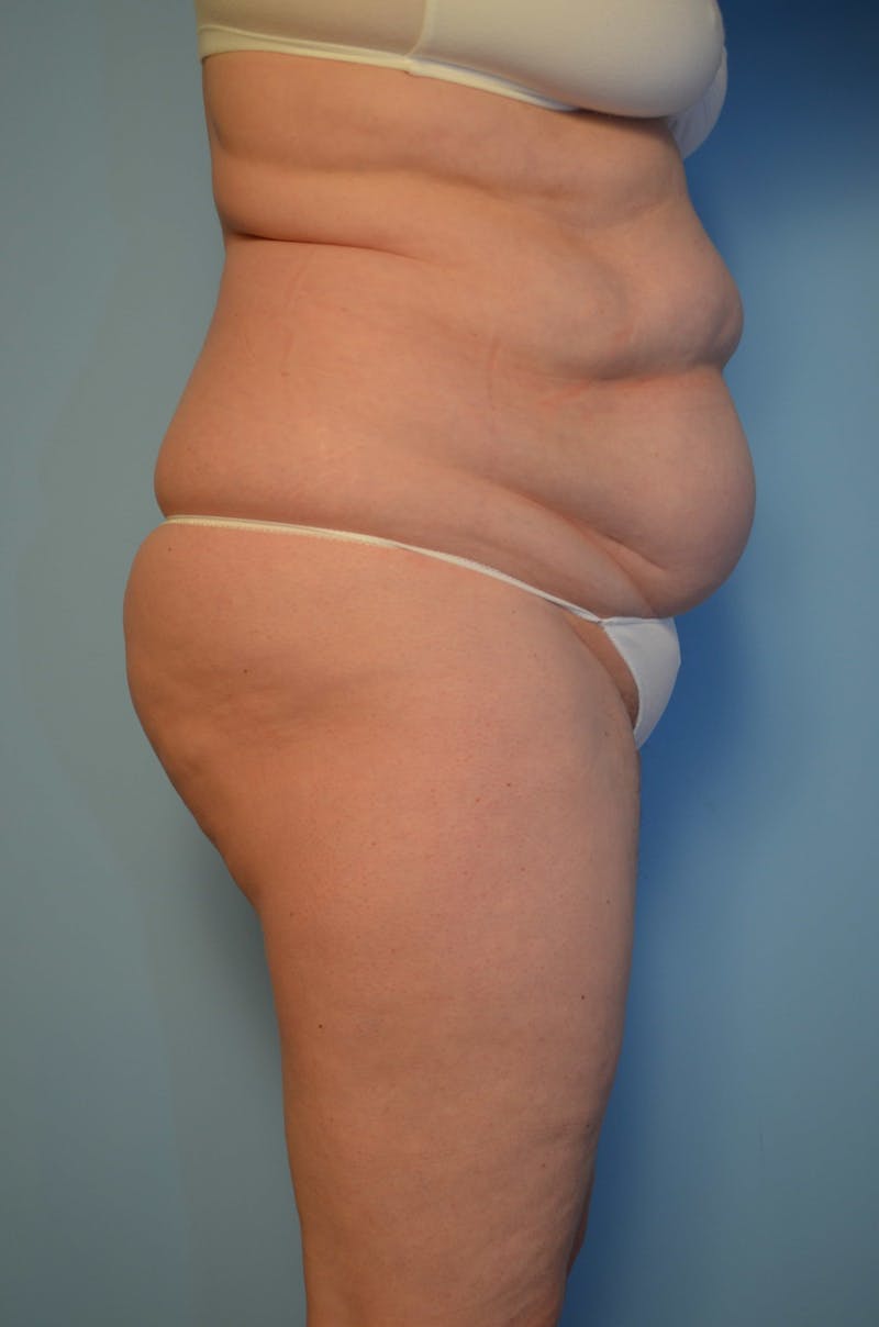 Tummy Tuck Before & After Gallery - Patient 405343 - Image 5