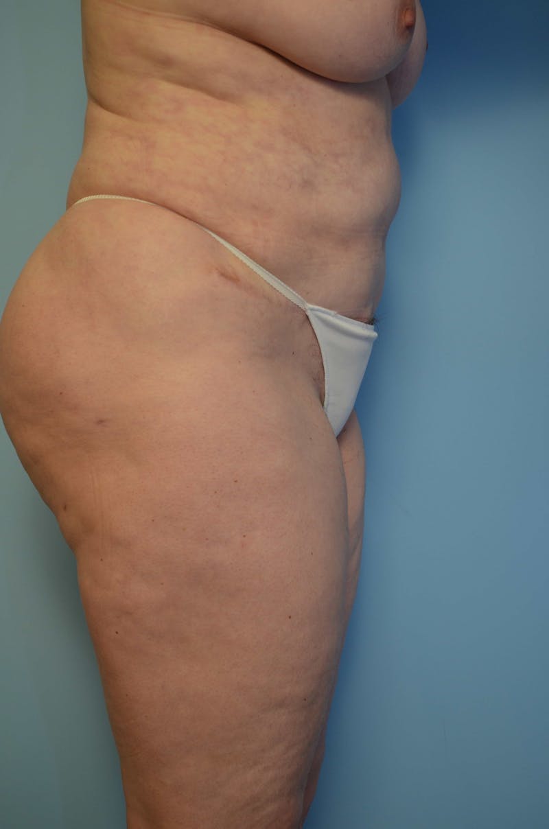 Tummy Tuck Before & After Gallery - Patient 405343 - Image 6