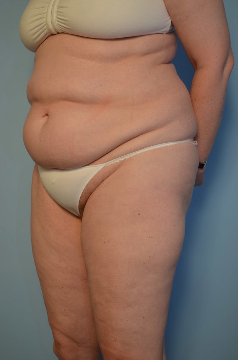Tummy Tuck Before & After Gallery - Patient 405343 - Image 7