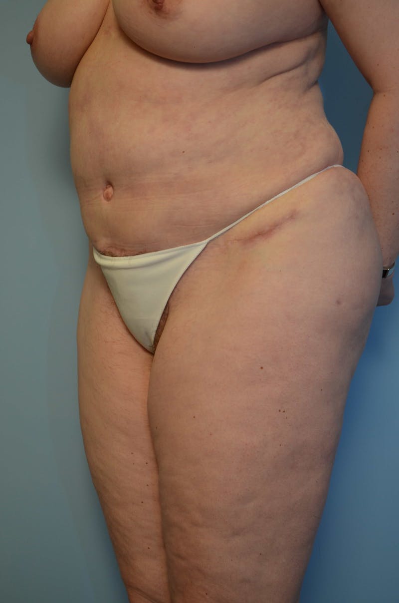 Tummy Tuck Before & After Gallery - Patient 405343 - Image 8