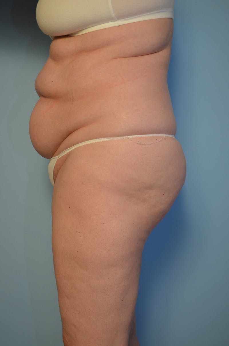 Tummy Tuck Before & After Gallery - Patient 405343 - Image 9