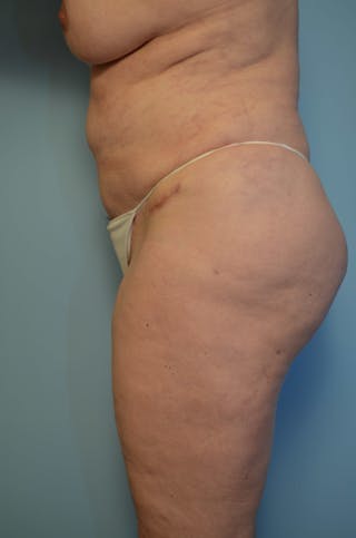Tummy Tuck Before & After Gallery - Patient 405343 - Image 10