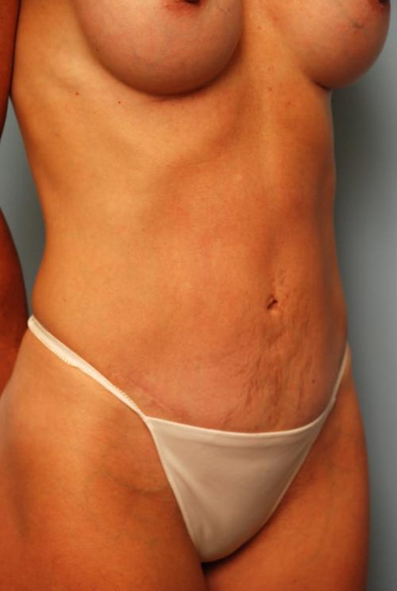 Umbilical Float Tummy Tuck Before & After Gallery - Patient 451173 - Image 4