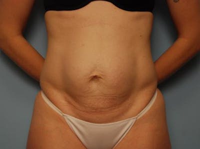 Umbilical Float Tummy Tuck Before & After Gallery - Patient 305547 - Image 1