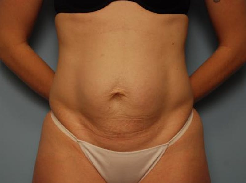 Umbilical Float Tummy Tuck Before & After Gallery - Patient 502398 - Image 1