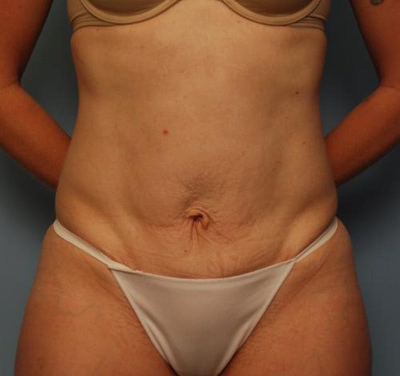 Umbilical Float Tummy Tuck Before & After Gallery - Patient 502398 - Image 2