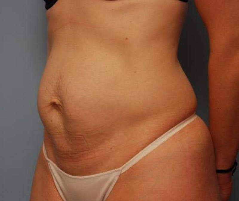 Umbilical Float Tummy Tuck Before & After Gallery - Patient 502398 - Image 7
