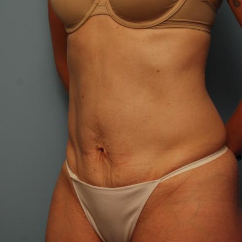 Umbilical Float Tummy Tuck Before & After Gallery - Patient 502398 - Image 8