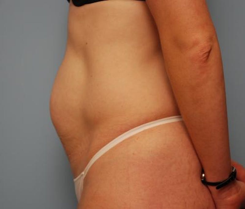 Umbilical Float Tummy Tuck Before & After Gallery - Patient 502398 - Image 9