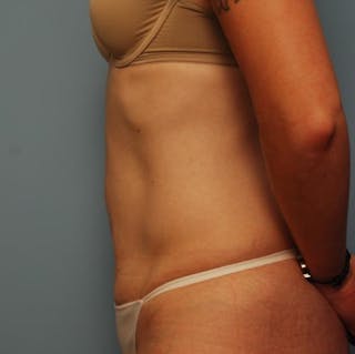 Umbilical Float Tummy Tuck Before & After Gallery - Patient 502398 - Image 10