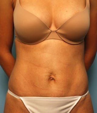 Umbilical Float Tummy Tuck Before & After Gallery - Patient 125084 - Image 2
