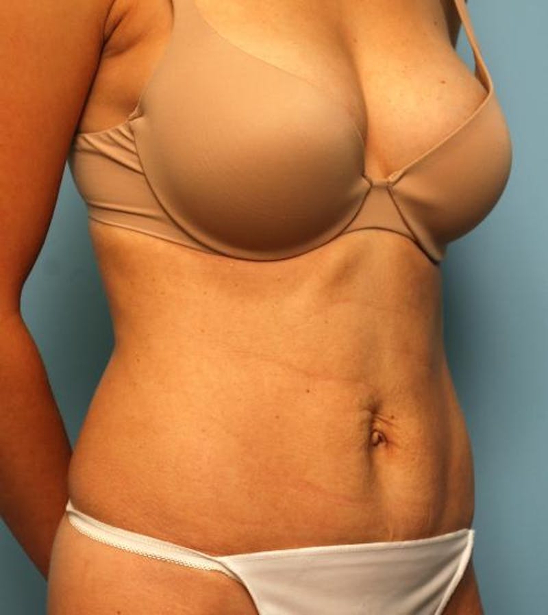Umbilical Float Tummy Tuck Before & After Gallery - Patient 125084 - Image 4
