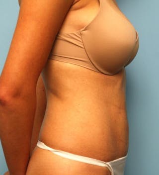 Umbilical Float Tummy Tuck Before & After Gallery - Patient 125084 - Image 6