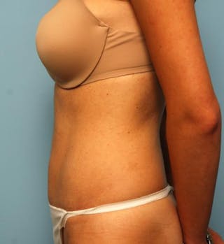 Umbilical Float Tummy Tuck Before & After Gallery - Patient 125084 - Image 10