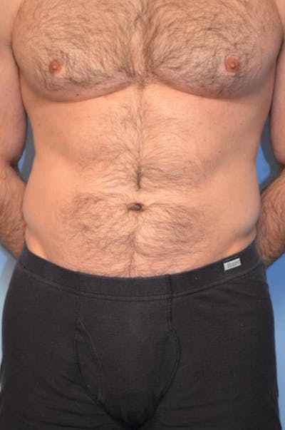 Umbilical Float Tummy Tuck Before & After Gallery - Patient 367553 - Image 1
