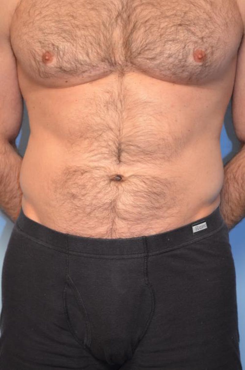 Umbilical Float Tummy Tuck Before & After Gallery - Patient 370192 - Image 1
