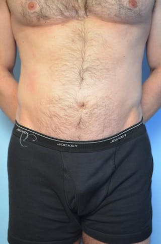 Umbilical Float Tummy Tuck Before & After Gallery - Patient 370192 - Image 2