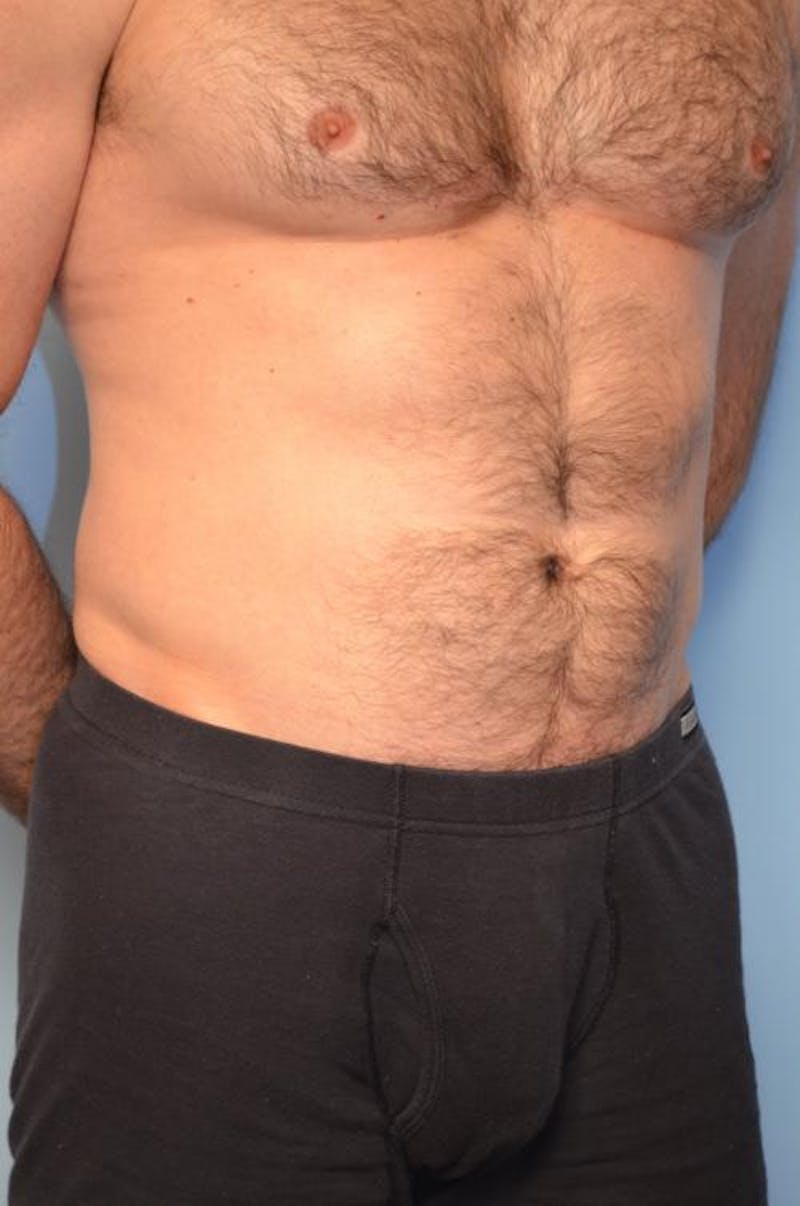 Umbilical Float Tummy Tuck Before & After Gallery - Patient 370192 - Image 3