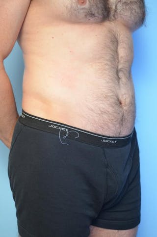 Umbilical Float Tummy Tuck Before & After Gallery - Patient 370192 - Image 4