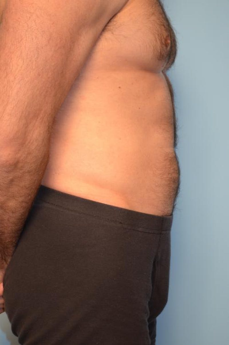 Umbilical Float Tummy Tuck Before & After Gallery - Patient 370192 - Image 5