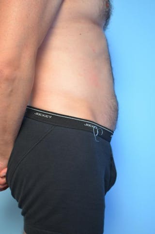 Umbilical Float Tummy Tuck Before & After Gallery - Patient 370192 - Image 6