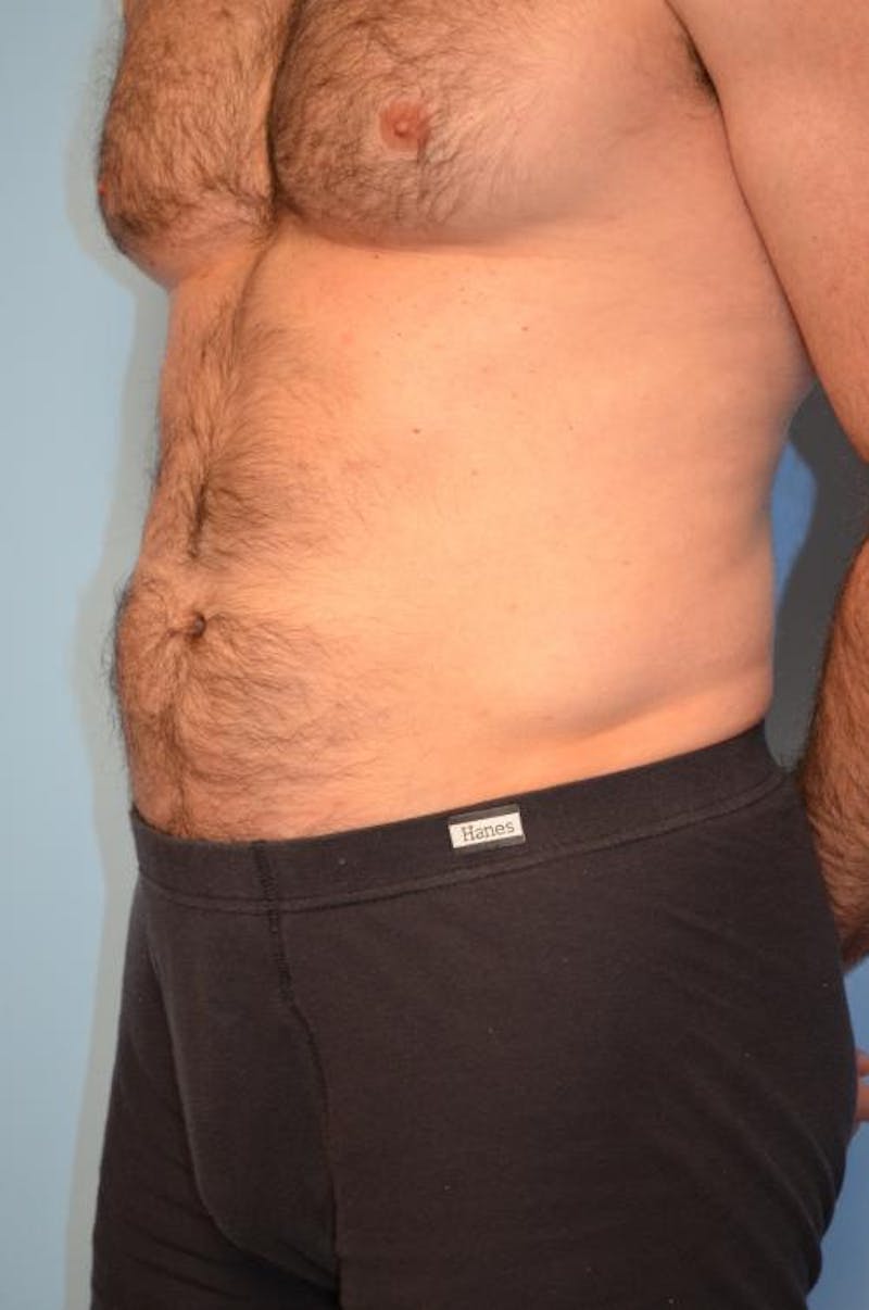 Umbilical Float Tummy Tuck Before & After Gallery - Patient 370192 - Image 7