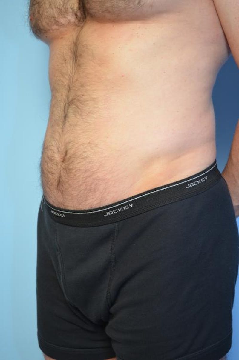 Umbilical Float Tummy Tuck Before & After Gallery - Patient 370192 - Image 8