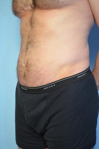 Umbilical Float Tummy Tuck Before & After Gallery - Patient 370192 - Image 8
