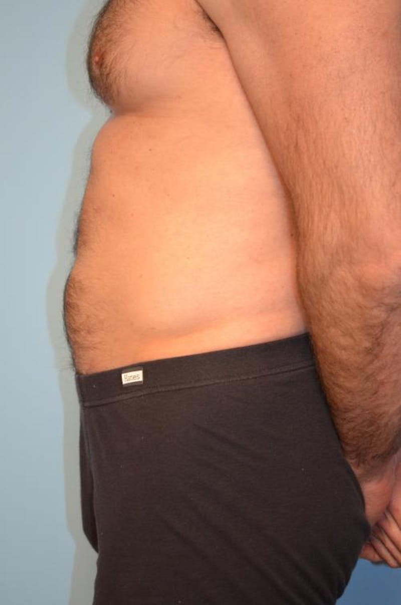 Umbilical Float Tummy Tuck Before & After Gallery - Patient 370192 - Image 9