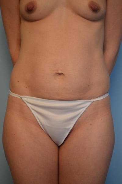 Umbilical Float Tummy Tuck Before & After Gallery - Patient 142215 - Image 1