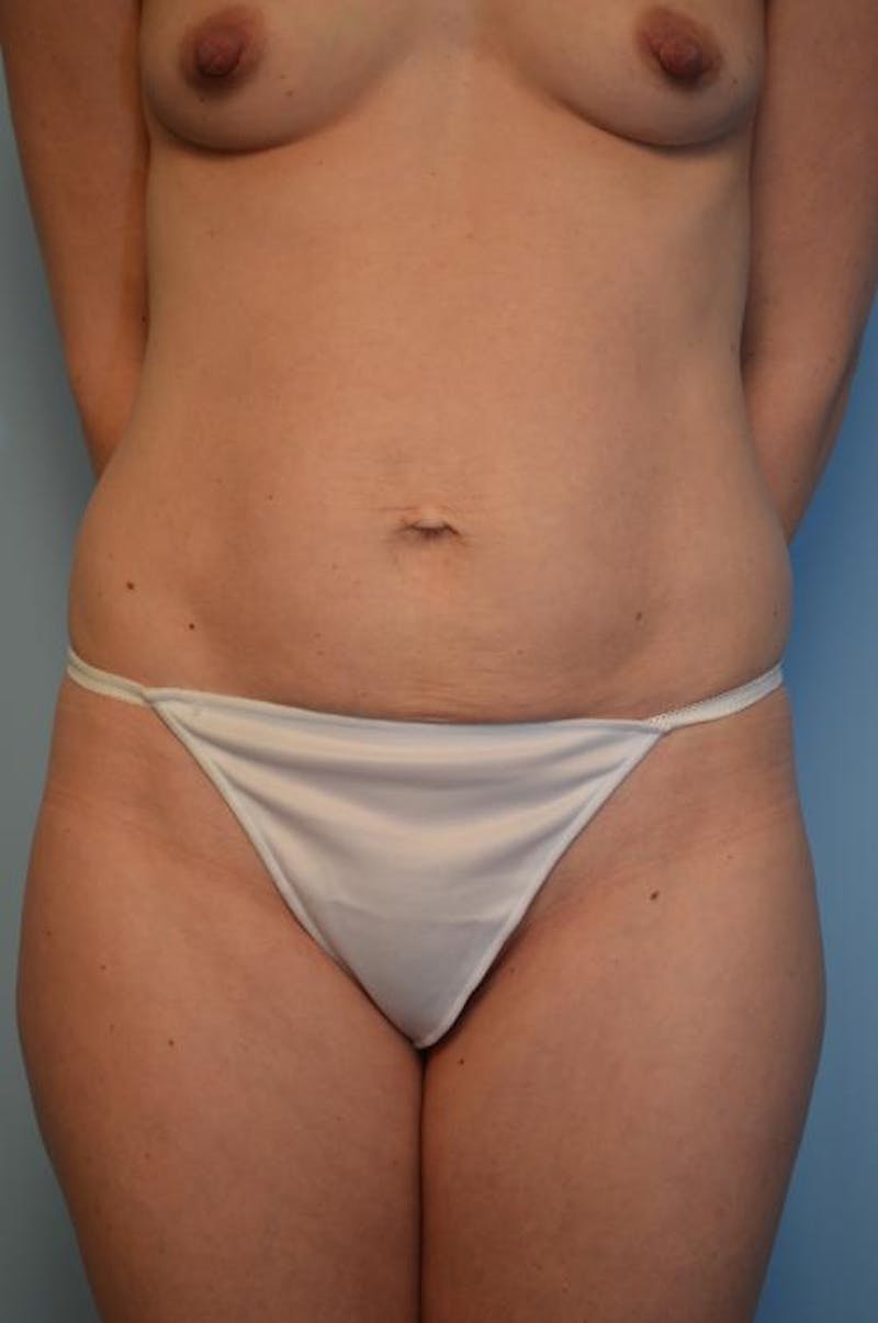 Umbilical Float Tummy Tuck Before & After Gallery - Patient 342340 - Image 1