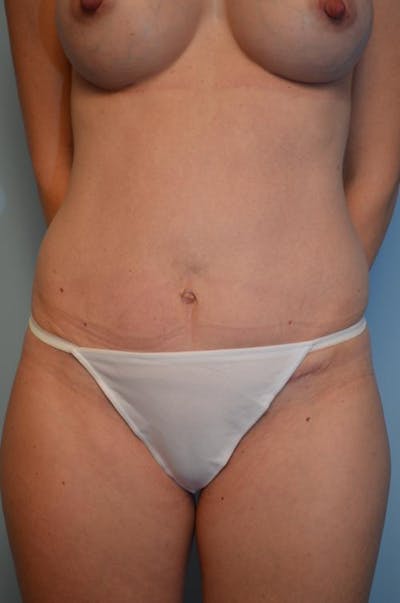 Umbilical Float Tummy Tuck Before & After Gallery - Patient 142215 - Image 2