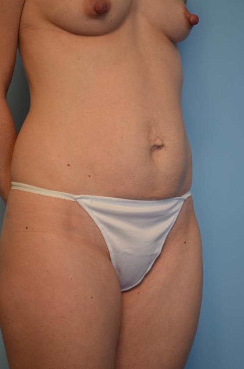 Umbilical Float Tummy Tuck Before & After Gallery - Patient 342340 - Image 3