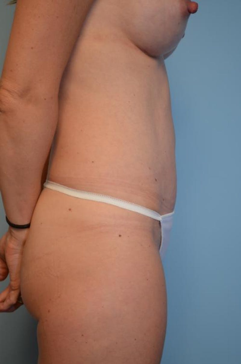 Umbilical Float Tummy Tuck Before & After Gallery - Patient 342340 - Image 6