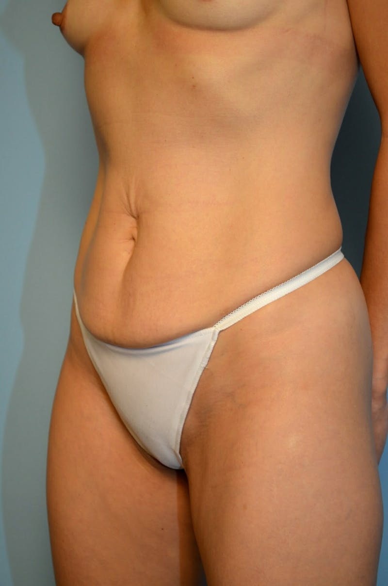 Umbilical Float Tummy Tuck Before & After Gallery - Patient 217365 - Image 3