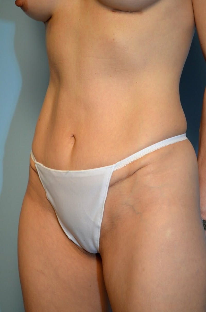 Umbilical Float Tummy Tuck Before & After Gallery - Patient 217365 - Image 4