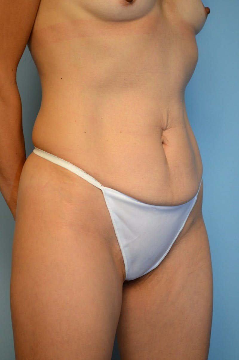 Umbilical Float Tummy Tuck Before & After Gallery - Patient 217365 - Image 7