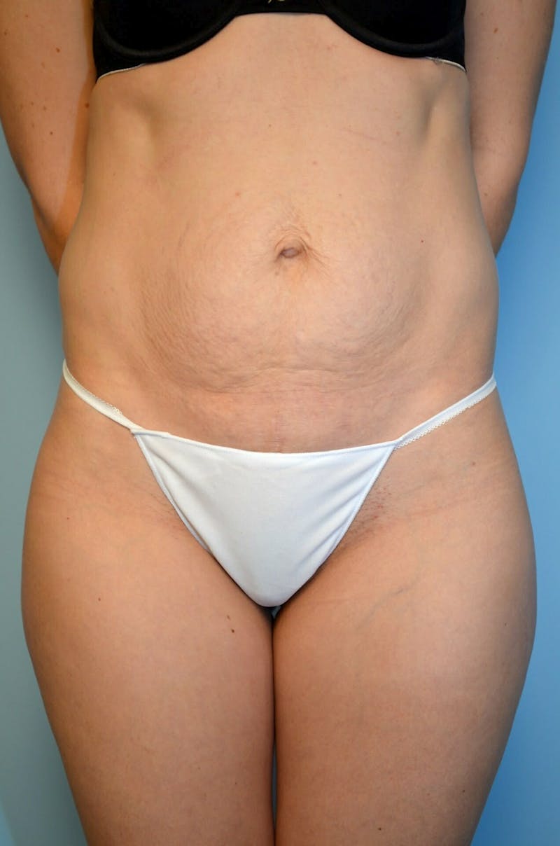 Umbilical Float Tummy Tuck Before & After Gallery - Patient 322179 - Image 1